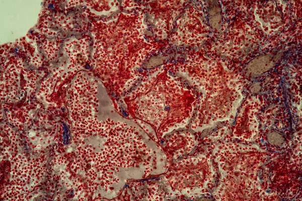 Tkáň Plicní Tuberkulózy Pod Mikroskopem 200X — Stock fotografie