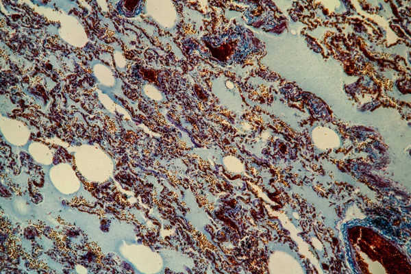 Tkanka Płucna Grypy Pod Mikroskopem 200X — Zdjęcie stockowe