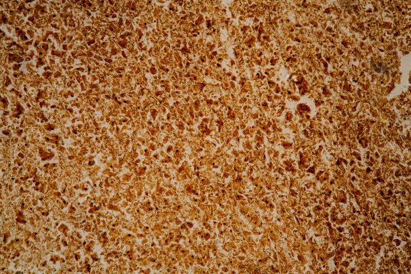 Spirocheteen Tkanki Wątroby Syfilis Pod Mikroskopem 200X — Zdjęcie stockowe