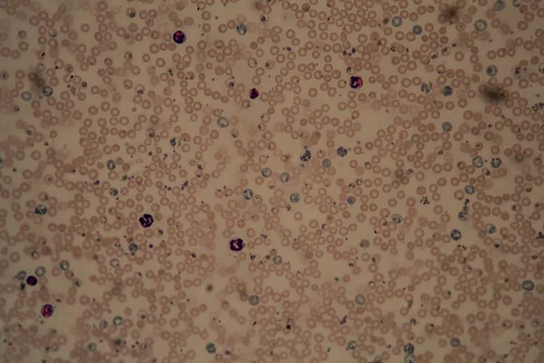 Malariaparasiter Röda Blodkroppar Mikroskop 400X — Stockfoto