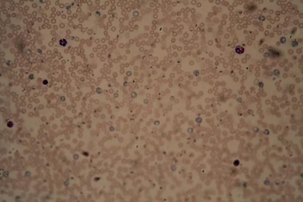Parassiti Della Malaria Nei Globuli Rossi Microscopio 400X — Foto Stock
