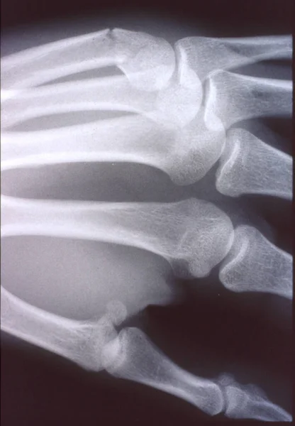Imagen Rayos Hombre Mano Con Huesos Articulaciones — Foto de Stock