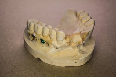 Alçı modeli olarak üst çene izi