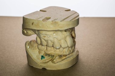 Gebiss mit Implantaten als Gipsmodell