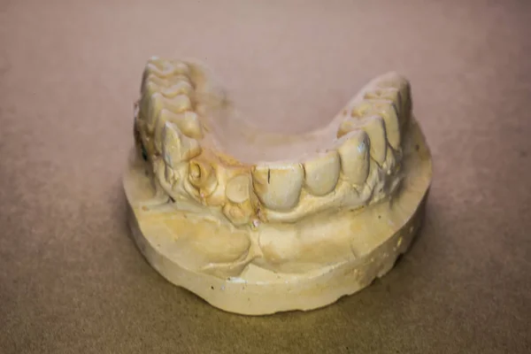 Upper jaw impression as a plaster model