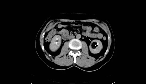 Abdomen Humano Hombre Tomografía Computada —  Fotos de Stock