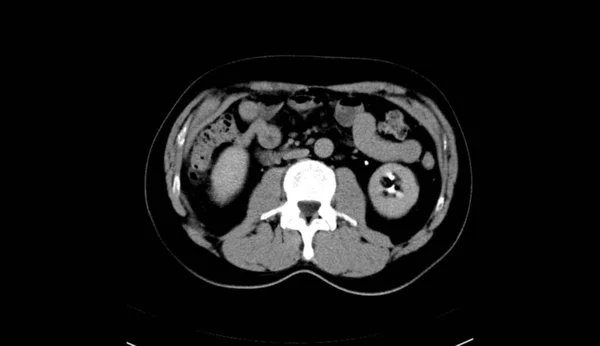 Abdomen Humano Hombre Tomografía Computada —  Fotos de Stock