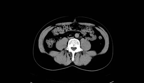 Abdomen Humano Hombre Tomografía Computada —  Fotos de Stock