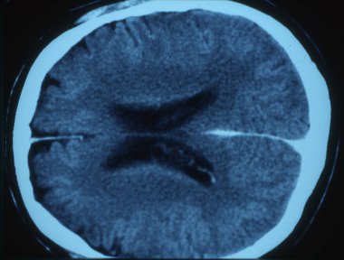 Röntgen görüntüsünde beyni olan insan kafası.