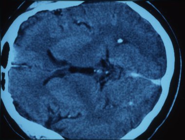 Röntgen görüntüsünde beyni olan insan kafası.