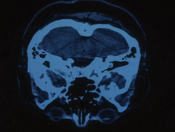 X光图像中的人头和大脑 — 图库照片