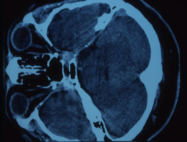 Людська Голова Мозком Рентгенівському Зображенні — стокове фото