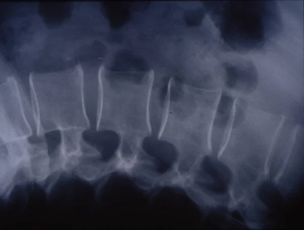 Imagen Rayos Columna Vertebral Para Diagnóstico Médico — Foto de Stock