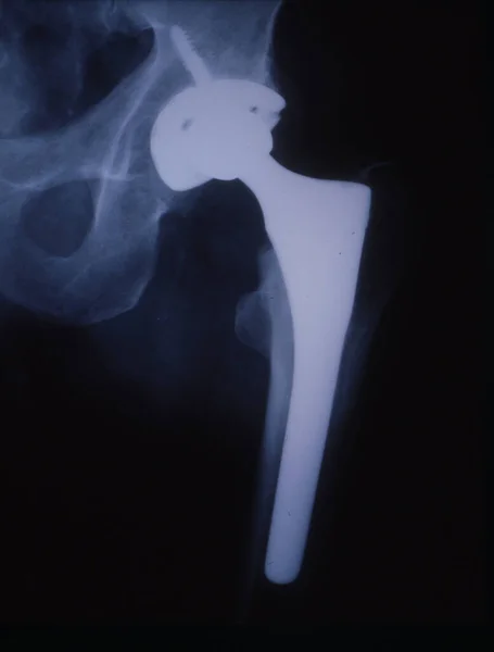 Artificial Hip Joint Imagen Rayos Del Muslo Humano — Foto de Stock