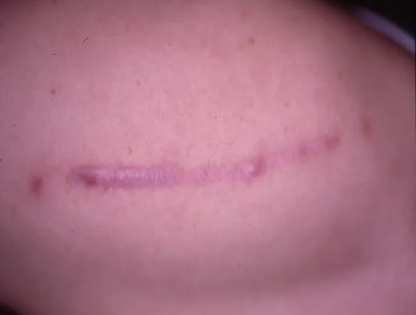 Cicatriz Brazo Mensch Después Del Accidente — Foto de Stock