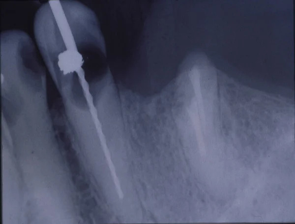 Imagen Rayos Dientes Con Empastes Puentes — Foto de Stock