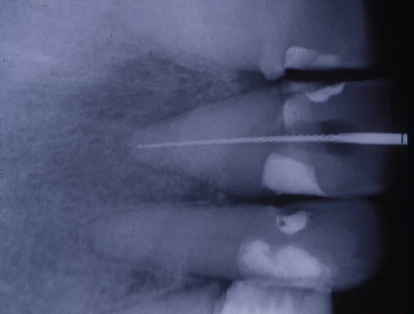 有填充物和桥的牙齿的X光图像 — 图库照片