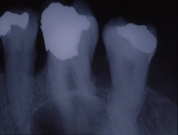 Imagen Rayos Dientes Con Empastes Puentes — Foto de Stock