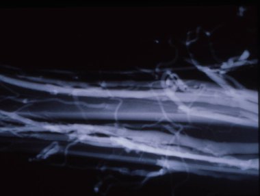 X-ray görüntüsünde varisli damarlar
