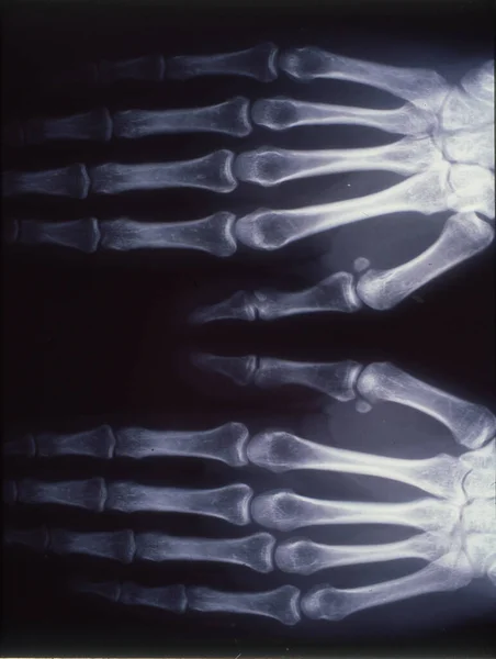 Imagen Rayos Hombre Mano Con Huesos Articulaciones — Foto de Stock