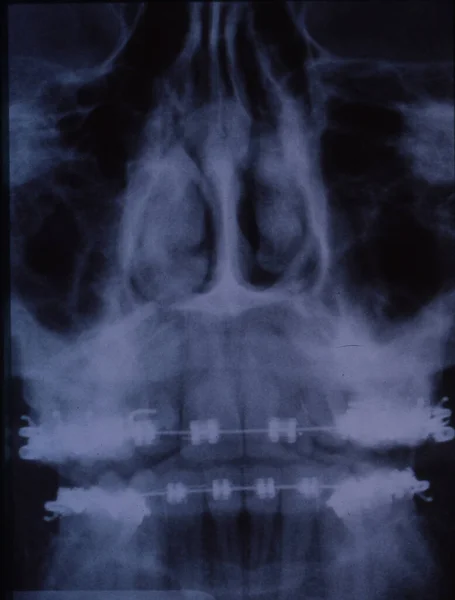 Imagen Radiográfica Dentición Con Aparatos Ortopédicos Dientes — Foto de Stock