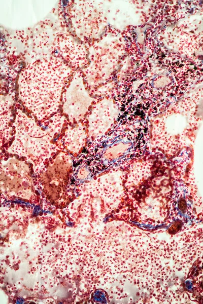 Tkanka Gruźlicy Pod Mikroskopem 100X — Zdjęcie stockowe
