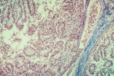 Mikroskop altında karaciğer dokusunun koksidiyozu 100 x