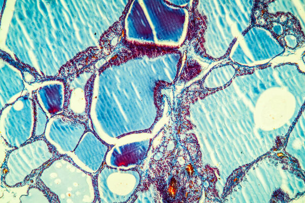 Goiter thyroid tissue with colloid 100x