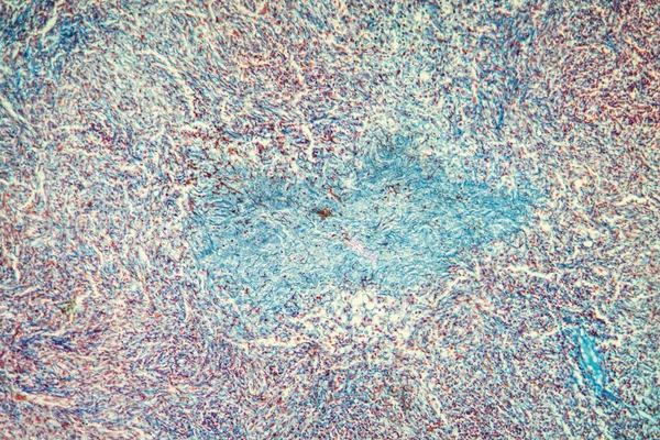 Cancro Tecido Vesícula Biliar Sob Microscópio 100X — Fotografia de Stock