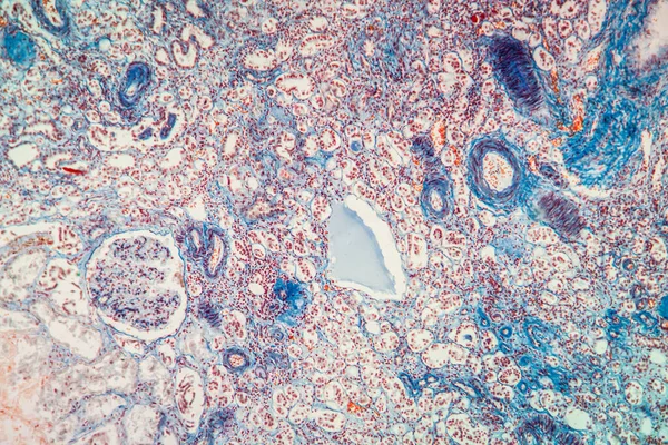 Atrofia Tkanki Nerkowej Pod Mikroskopem 100X — Zdjęcie stockowe