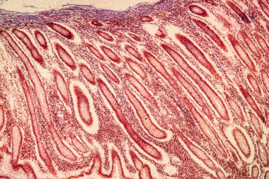 Kolon kanserinin kolon kanseri. Hastalıklı doku 100 kat.