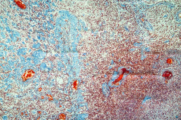 Melanoma skin cancer Diseased tissue 100x