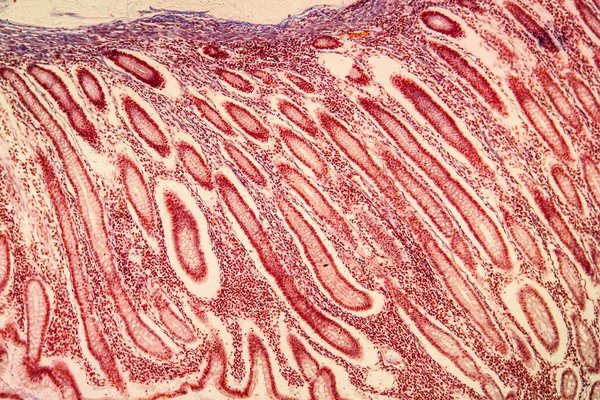 Рак Товстої Кишки Захворювана Тканина 100Х — стокове фото