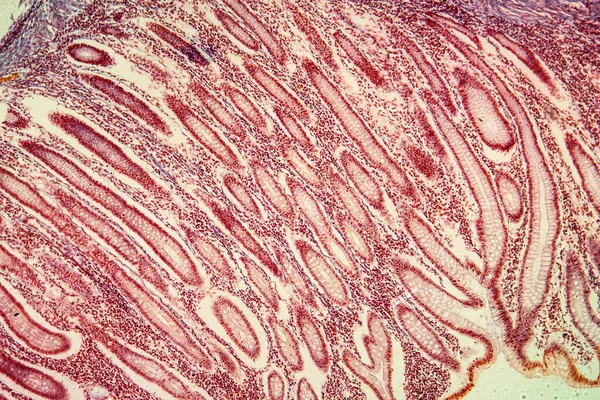 結腸疾患組織の結腸がん100倍 — ストック写真
