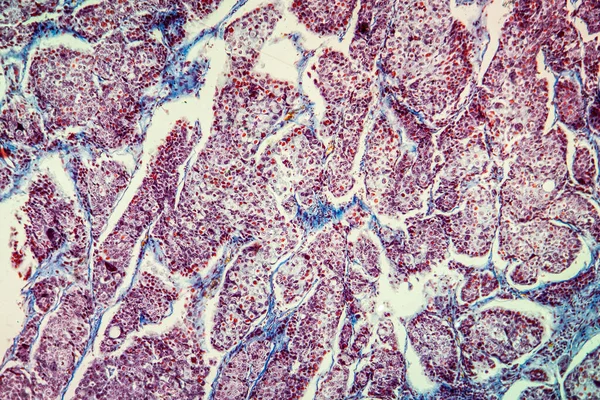 Basal cell cancer Diseased tissue 100x