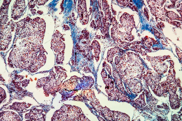 Karcinom Bazocelulárních Buněk Nemocná Tkáň 100X — Stock fotografie