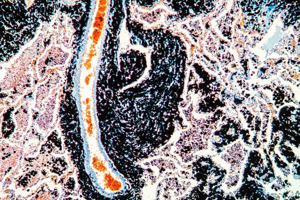Kohlenstaub Lungengewebe Unter Dem Mikroskop 100X — Stockfoto