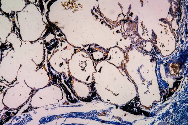 Tkanka Płucna Pyłu Drzewnego Pod Mikroskopem 100X — Zdjęcie stockowe