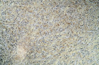 Çenedeki oyunculuk Hastalıklı doku 200x