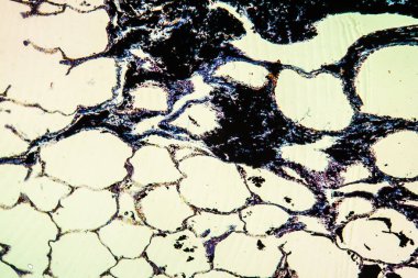 Kömür tozu akciğeri hastalıklı doku 100 kat