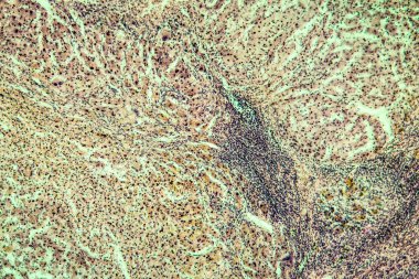 Alkol kullanımından sonra karaciğer sirozu dokusu 100 kat etkilenmiş.