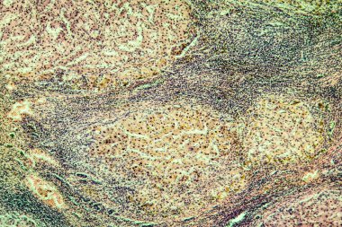 Alkol kullanımından sonra karaciğer sirozu dokusu 100 kat etkilenmiş.