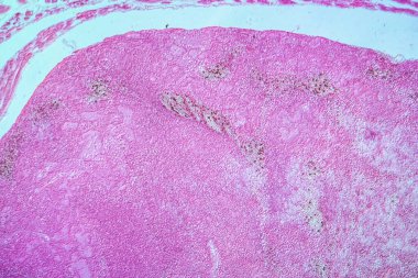 Doku alkolizmle hastalıklandı. 100 kat.