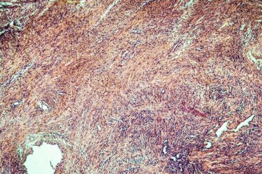 Kardiyak kas iltihabı hastalıklı doku 100x