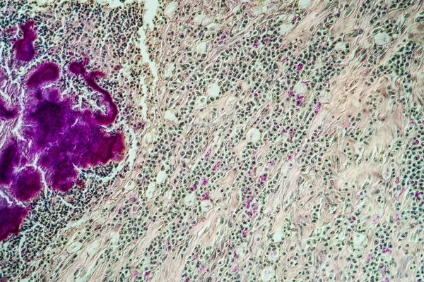 Attinomie Nella Mandibola Tessuto Malato 200X — Foto Stock