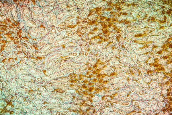 Billirubin Kidney Diseased Tissue 100X — 图库照片