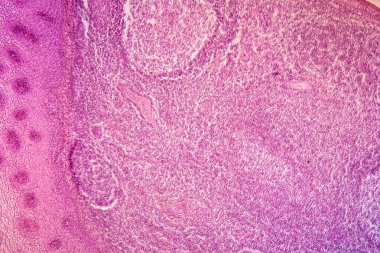 Damak bademcikleri iltihaplanmış doku iltihabı. 100 kat.