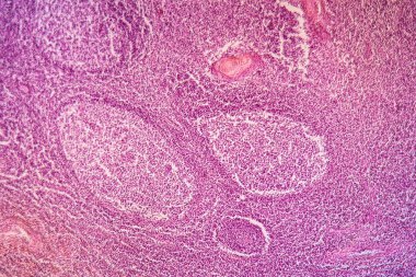 Damak bademcikleri iltihaplanmış doku iltihabı. 100 kat.