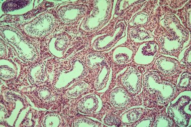 Inguinal testisler gonadik olarak hastalıklı doku 100 kat