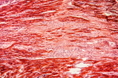 Yumurtalık dokusunun kisti 100x